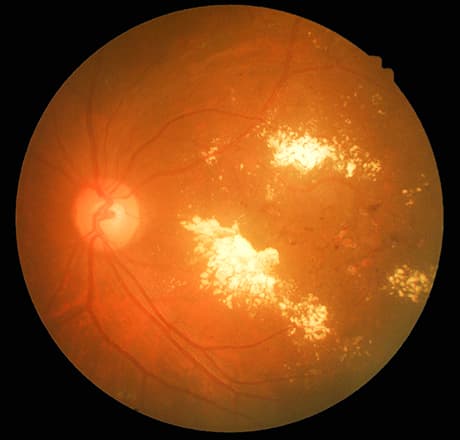 Diabetic Retinopathy