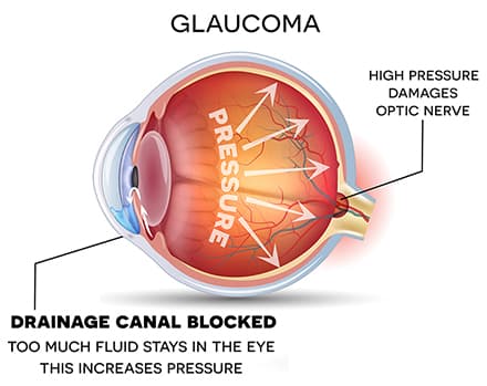 Glaucoma Diagram