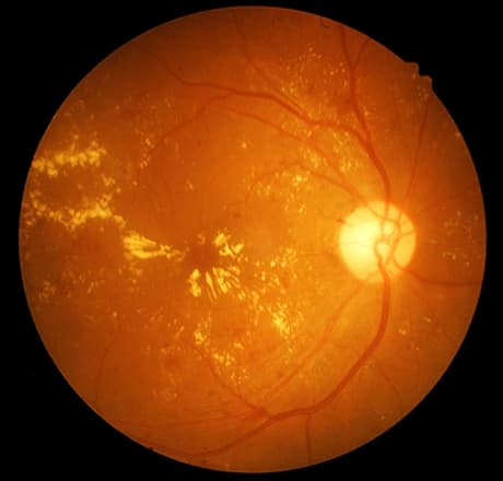 Retina with Macular Degeneration