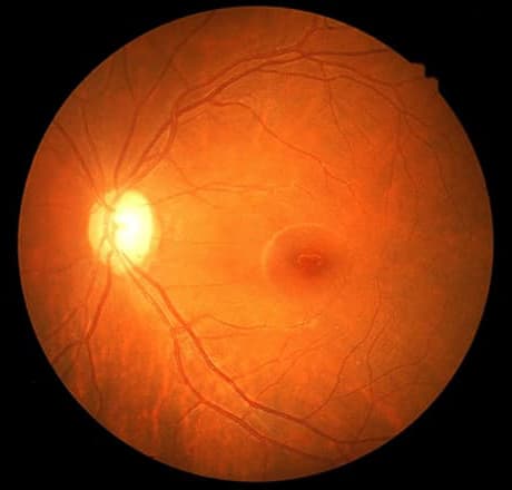 Normal Retina