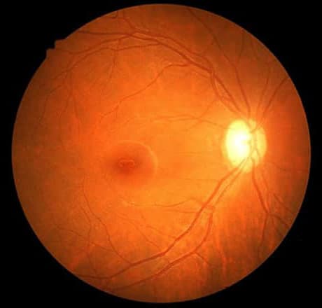 Normal Retina